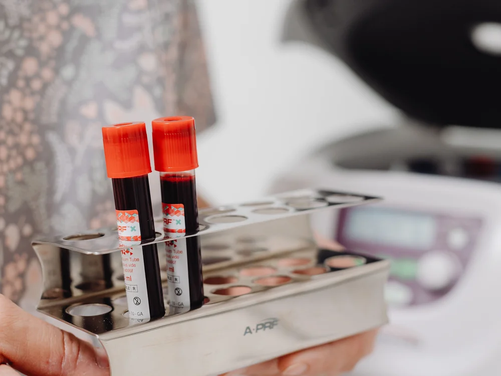 Who needs therapeutic phlebotomy in Washington DC
