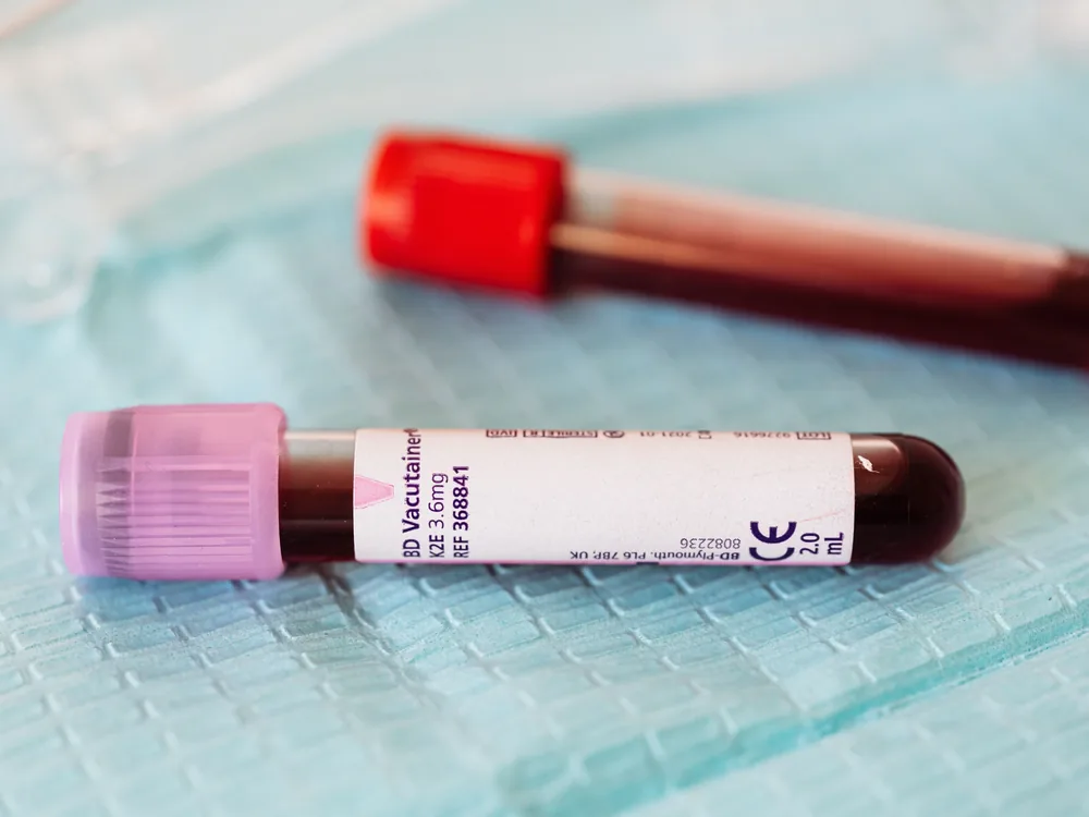 therapeutic phlebotomy patients we serve in Virginia, hemochromatosis and polycythemia vera care